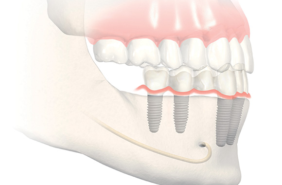 All-on-4-Draveil - implant dentaire draveil