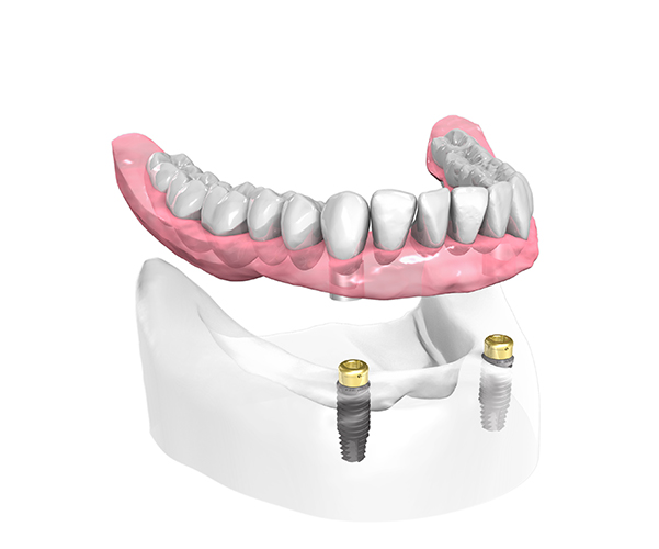 Implant dentaire Draveil